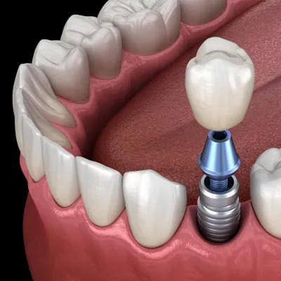 Implantat Implantat
