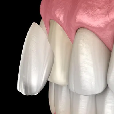 Veneers Veneers